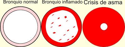 El asma en los niños (I) El asma en los niños (I)