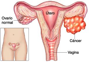 El cáncer de ovarios – algunas consideraciones a tomar en cuenta