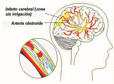 ¿Cómo prevenir un ACV?