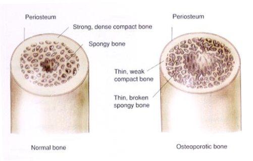 Osteoporosis, qué es y cómo prevenirla Osteoporosis, qué es y cómo prevenirla