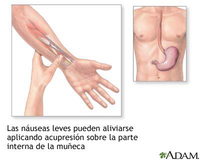 ¿Cuáles son los puntos de acupresión para el alivio Náuseas y vómitos