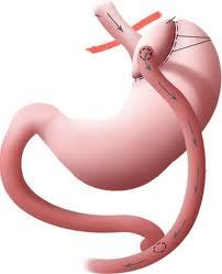 El bypass gástrico aumenta el riesgo de abuso de alcohol El bypass gástrico aumenta el riesgo de abuso de alcohol