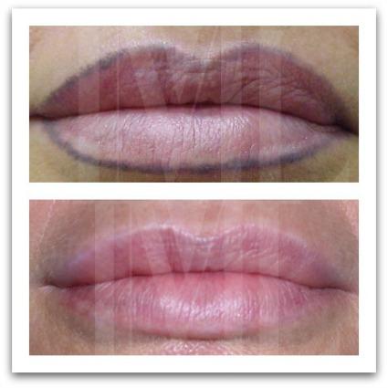 Eliminación de tatuajes de forma segura en IML Eliminación de tatuajes de forma segura en IML