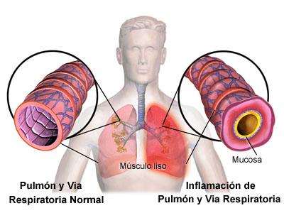 Como se presenta la bronquitis en nuestro organismo
