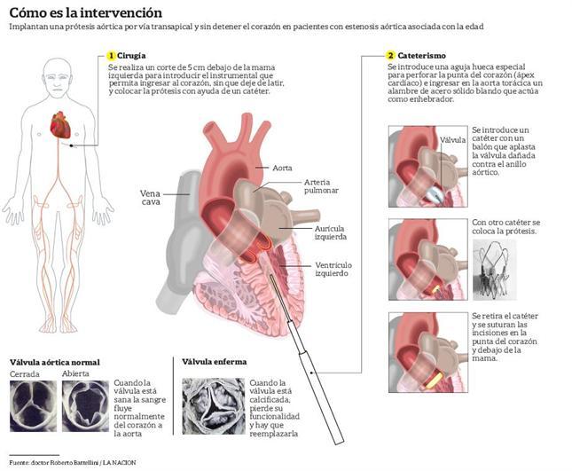 Operacion inedita en la Argentina, sin detener el corazon.