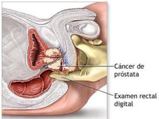 Cuidados y chequeos para evitar el cáncer de próstata