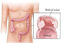 La obesidad aumenta el riesgo de padecer cáncer de colon
