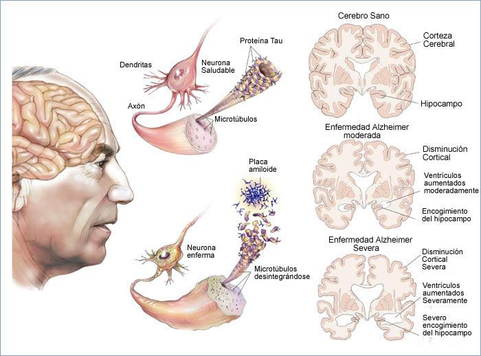 El primer caso de Alzheimer tiene un diagnóstico completo después de 106 años alzeimer2-0987654321