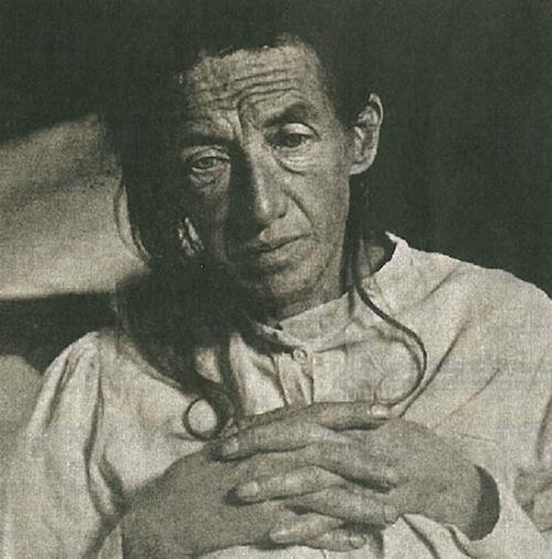 El primer caso de Alzheimer tiene un diagnóstico completo después de 106 años Auguste Deter