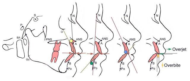 ¿Ortodoncia, dientes chuecos, maloclusion? Dudas y respuestas