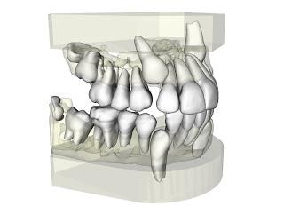 ¿Ortodoncia, dientes chuecos, maloclusion? Dudas y respuestas