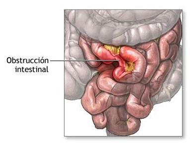La oclusión intestinal aguda como enfermedad de intervención rápida