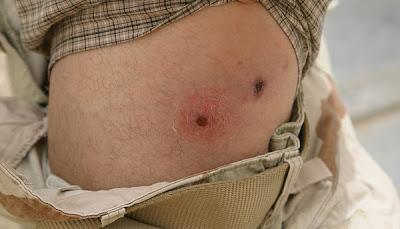 Mordeduras y picaduras Mordeduras y picaduras