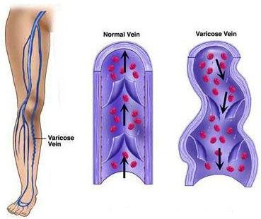 Avances en el tratamiento de varices Varices