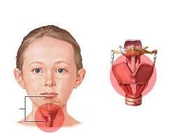 Que es la laringitis, causas, síntomas y tratamiento