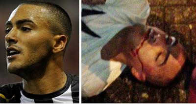 HERIDO EN UNA PELEA DANNY SIMPSON, JUGADOR DEL NEWCASTLE