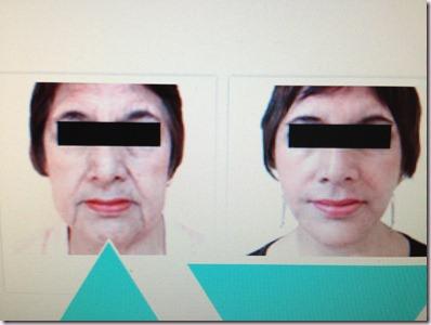 Tacha: NUEVO Lifting Biológico contra la flacidez y el descolgamiento facial imagen V lift Pro thumb Tacha: NUEVO Lifting Biológico contra la flacidez y el descolgamiento facial