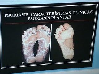 Psoriasis, una de las 15 amenazas de la piel más comunes en México