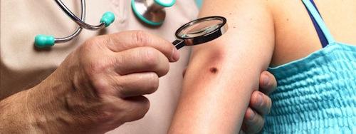Las variantes de cáncer de piel afectando a nuestro organismo