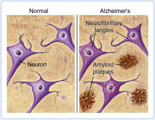 Marcas del Alzheimer Marcas del Alzheimer