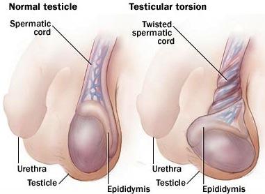 ¿Qué es la torsión de testículo? ¿Qué es la torsión de testículo?