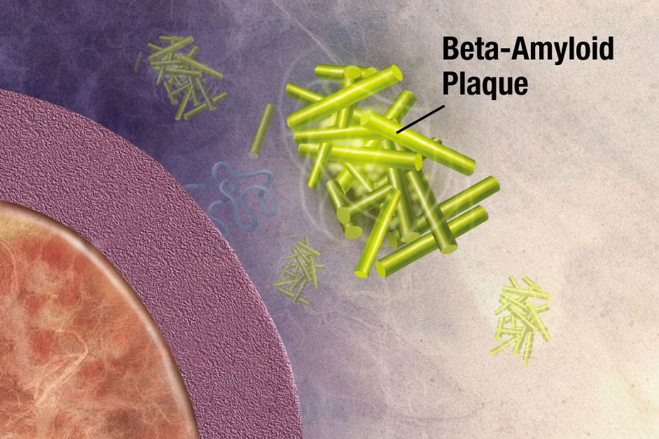 El Alzheimer da la mano –molecular- a la Esclerosis Múltiple El Alzheimer da la mano –molecular- a la Esclerosis Múltiple