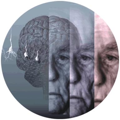El Alzheimer da la mano –molecular- a la Esclerosis Múltiple El Alzheimer da la mano –molecular- a la Esclerosis Múltiple