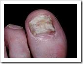 onicomicosis onicomicosis