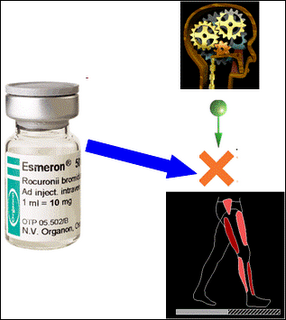 Cómo evitar que suceda: Estar despierto durante la cirugía a pesar de la anestesia (3) Cómo evitar que suceda: Estar despierto durante la cirugía a pesar de la anestesia (3)