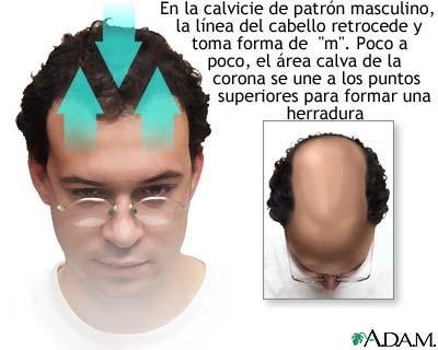 Hierbas para el crecimiento del cabello - Remedios herbarios para la pérdida del pelo