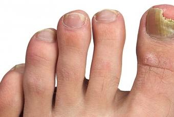 El hongo de las uñas por el permanganato