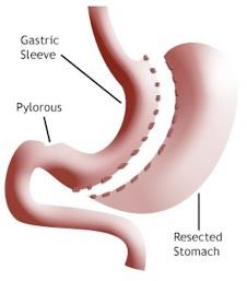 Todo sobre la anestesia para cirugía contra la obesidad: manga gástrica (1)
