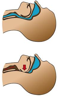 Todo sobre la anestesia en cirugía contra la obesidad: manga gástrica (2) Todo sobre la anestesia en cirugía contra la obesidad: manga gástrica (2)