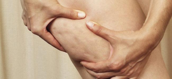 Sabemos ¿Qué es exactamente la Celulitis ? Aspecto de pierna con celulitis