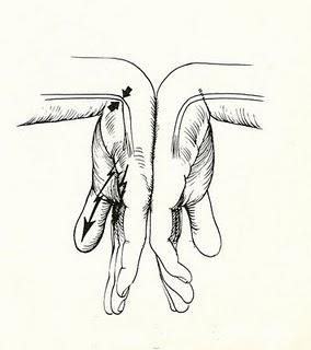 Signo de Phallen Síntomas del Síndrome del Túnel del Carpo