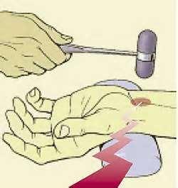 Signo de Tinel Sintomas del Sindrome del Tunel del carpo