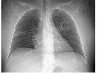 Se pone en marcha la Wikipedia pulmonar