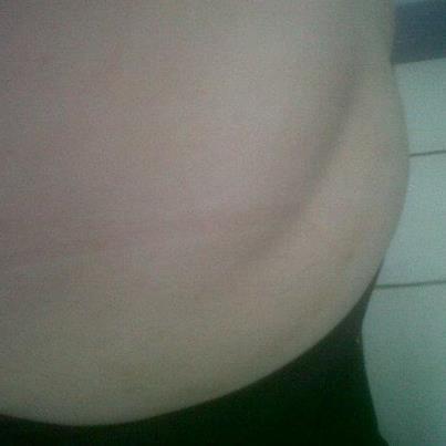 Hematoma glúteo encapsulado Foto: Caso clínico 63. Que es esta lesion en el gluteo.