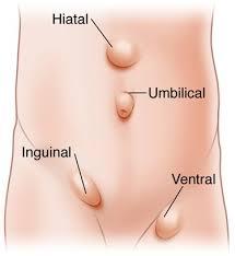 Qué es una hernia, porque hay que operar, cuánto dura la intervención