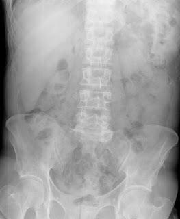 Lóbulo Hepático de Riedel Lóbulo Hepático de Riedel