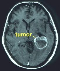 Meduloblastoma:Transformar el dolor en una oportunidad de amor Meduloblastoma:Transformar el dolor en una oportunidad de amor