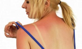 ¿Como aliviar las quemaduras de sol? ¿Como aliviar las quemaduras de sol?