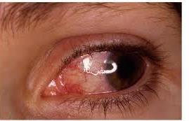 Cirugía de los ojos por desprendimiento de retina desprendimiento de retina