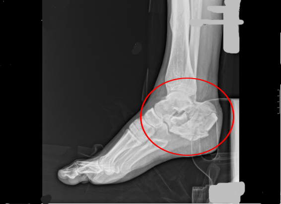 CASO CLINICO SOBRE FRACTURA DE CALCANEO EN MULTIPLES FRAGMENTOS