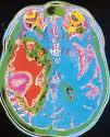 Se crea la Asociación de afectados por tumores cerebrales en España (ASATE) Se crea la Asociación de afectados por tumores cerebrales en España (ASATE)