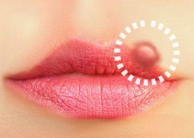 Novedades para el Tratamiento del Herpes Labial avances+para+el+tratamiento+del+herpes+labial