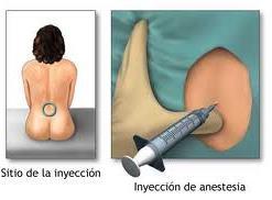 ¿Cómo es un parto con anestesia epidural? parto con anestesia epidural