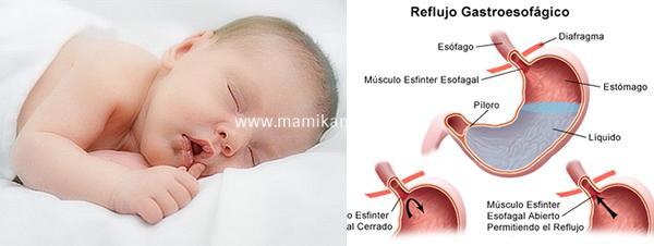 El reflujo de los bebés reflujo