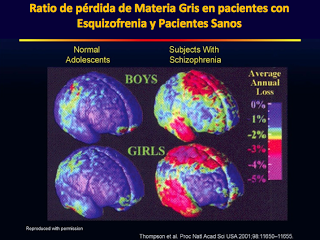 Consecuencias neurobiológicas de las recaídas en la esquizofrenia Consecuencias neurobiológicas de las recaídas en la esquizofrenia