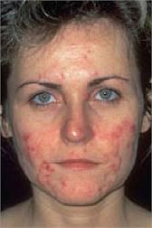 2 Consejos efectivos contra el acné